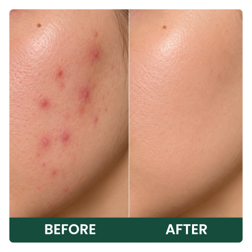 skin improvement
